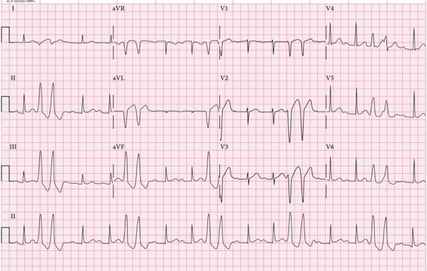 ECG showing couplet PVC