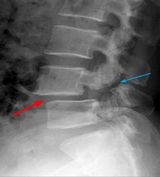 Spondylolisthesis grading Meyerding