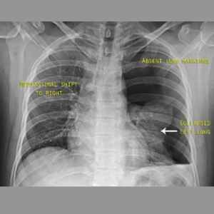 X-ray case 1 – pneumothorax
