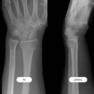 X-ray case 2 – Colles fracture