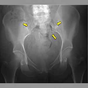 X-ray case 3 – ankylosing spondylitis