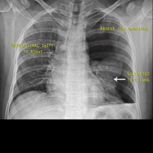 Chest X-ray at diagnosis